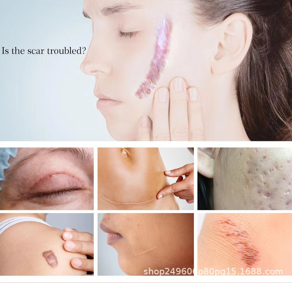 Yoxier Lavender Scar Repair Cream For all Scar Types, Stretchmarks Acne Scars, CS scars, Burns etc