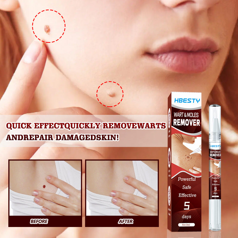 5 Days Powerful Wart Remover Essence